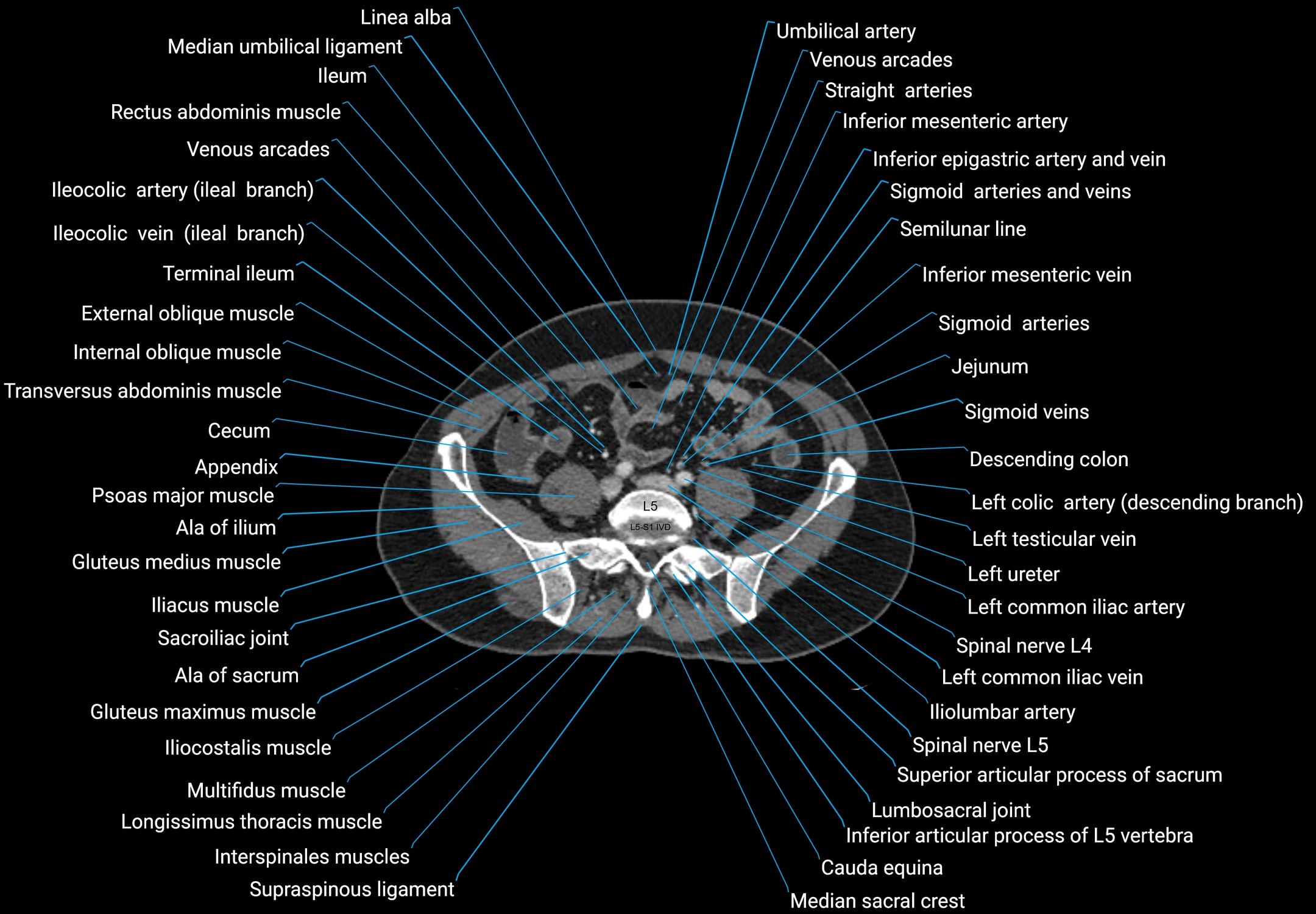 CT male pelvis axial cross sectional anatomy labelled radiology image -00133.webp